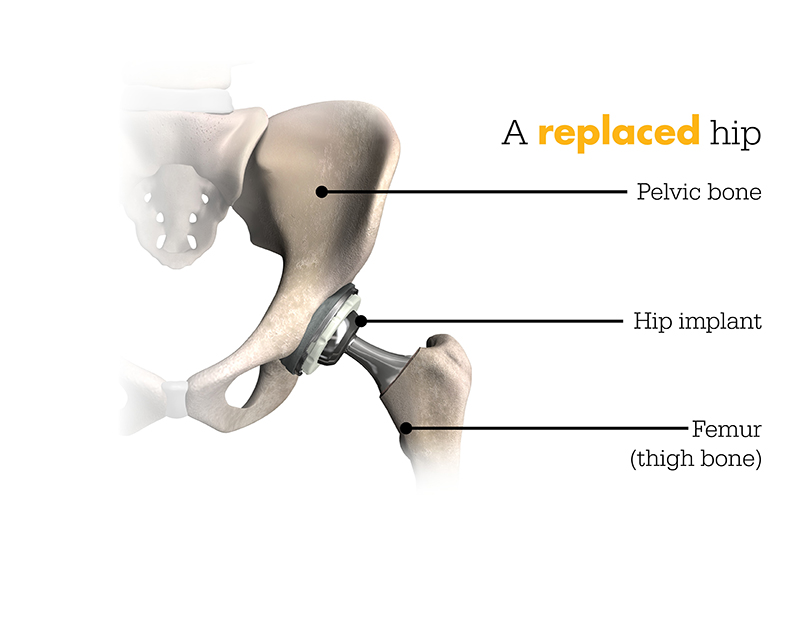 Total Hip Replacement - WatsonvilleHospital.com